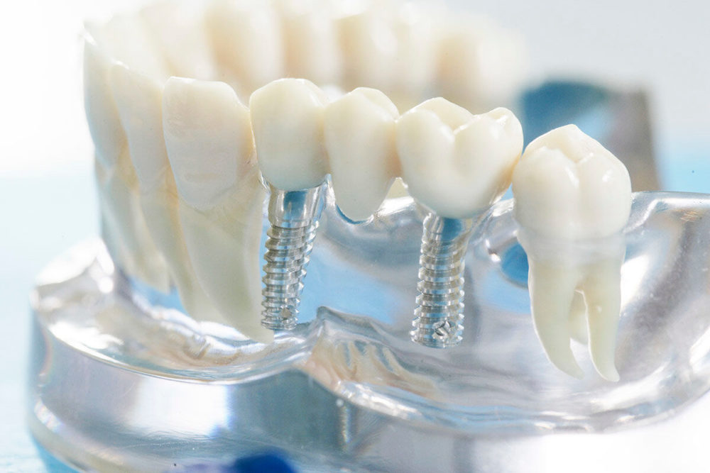 Какие бывают виды протезирования зубов