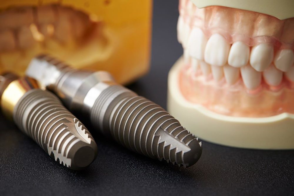 Что такое имплантация зубов и зачем она нужна?